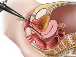 Что такое цистоскопия?